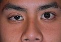 ptosis patient 